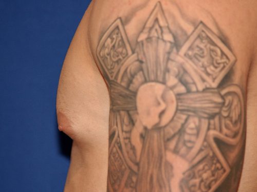 Gynecomastia 02 Before 3