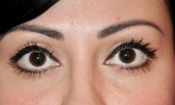 Eyelid Surgery 16 After