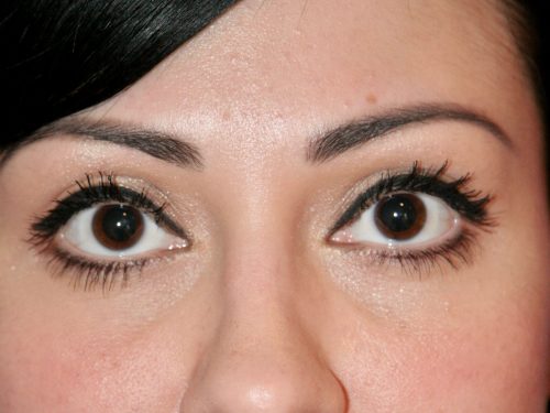 Eyelid Surgery 16 After 1