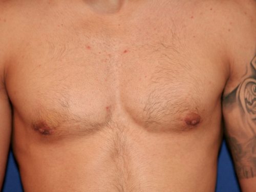 Gynecomastia 02 After 1