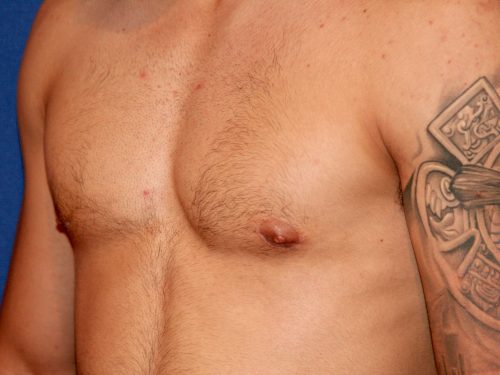 Gynecomastia 02 After 2