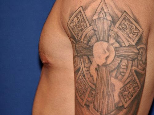 Gynecomastia 02 After 3