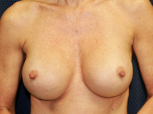 Breast Implant Exchange 05 Before 1