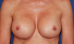 Breast Implant Exchange 05 After