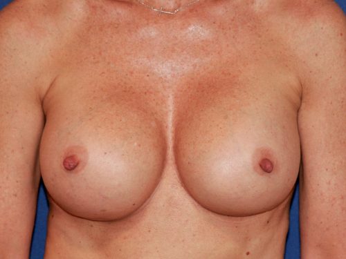 Breast Implant Exchange 05 After 1