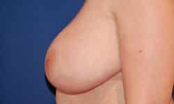 Breast Lift 07 Before