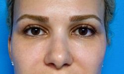 Buccal Fat Removal 06 After