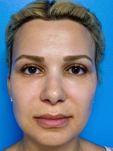 Buccal Fat Removal 06 After 1