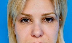 Buccal Fat Removal 06 Before