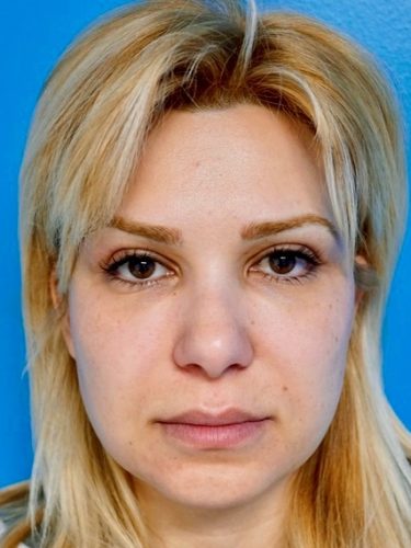 Buccal Fat Removal 06 Before 1