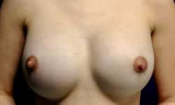 Breast Implant Exchange 06 Before