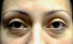 Eyelid Surgery 16 Before