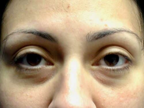 Eyelid Surgery 16 Before 1