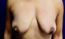 Breast Augmentation 15 Before