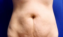 Tummy Tuck 14 Before