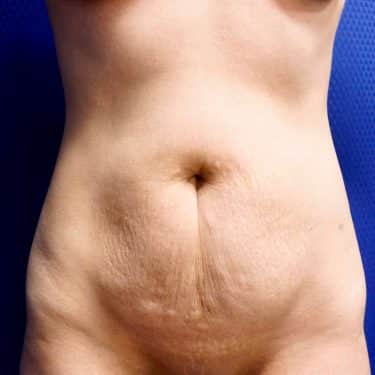 Tummy Tuck 14 Before 1