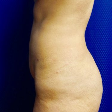 Tummy Tuck 14 Before 2