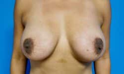 Breast Augmentation 15 After