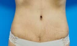 Tummy Tuck 14 After