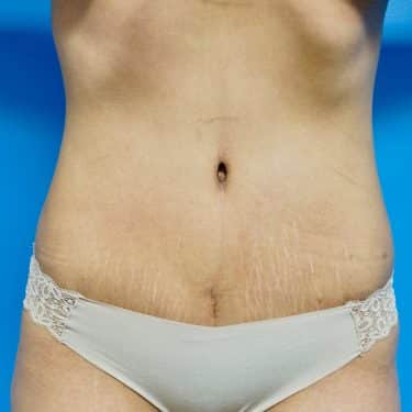 Tummy Tuck 14 After 1