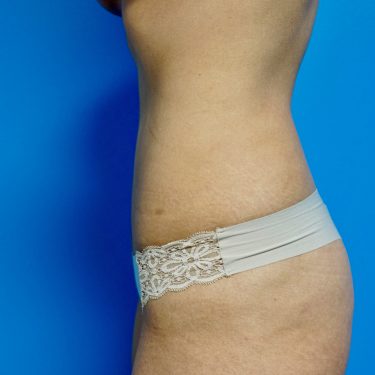 Tummy Tuck 14 After 2