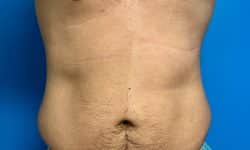CoolSculpting 05 After