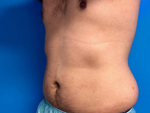 CoolSculpting 05 After 2