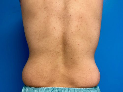 CoolSculpting 05 After 3