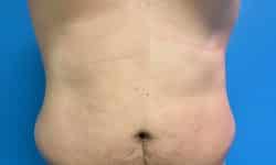 CoolSculpting 05 Before