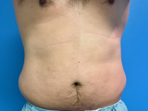 CoolSculpting 05 Before 1