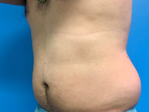 CoolSculpting 05 Before 2