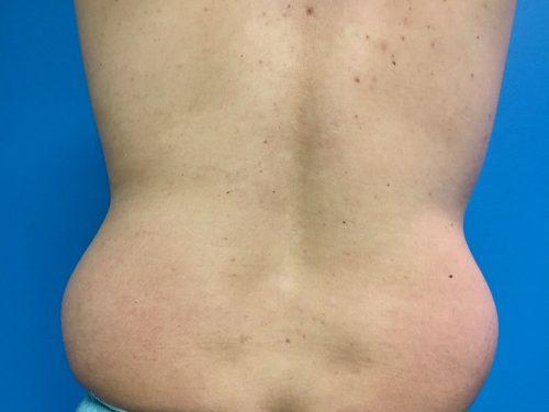 CoolSculpting 05 Before 3