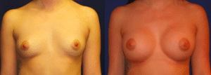 Breast Augmentation Dr Taylor