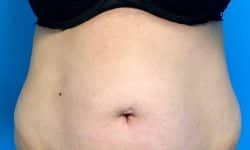 CoolSculpting 06 Before