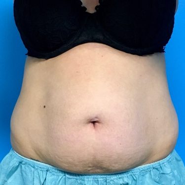 CoolSculpting 06 Before 1