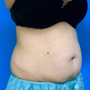 CoolSculpting 06 Before 2