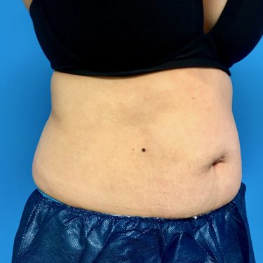 CoolSculpting 06 After 2