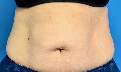 CoolSculpting 06 After