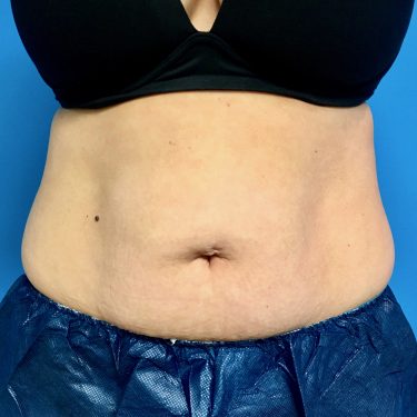CoolSculpting 06 After 1