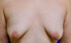 Breast Augmentation and Breast Lift 03 Before
