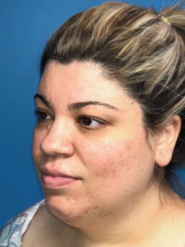 Liposuction 09 Before 2