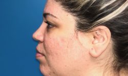 Liposuction 09 Before