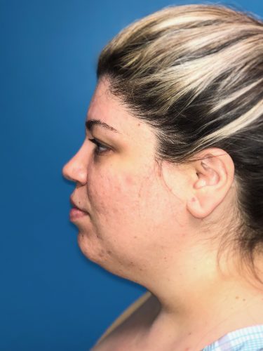 Liposuction 09 Before 1