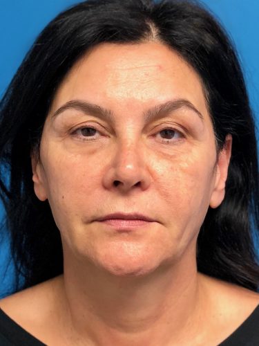 Facelift 14 Before 1