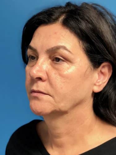 Facelift 14 Before 2