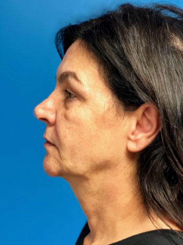 Facelift 14 Before 3