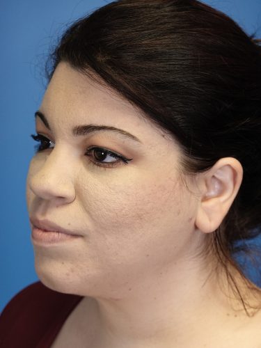 Liposuction 09 After 2