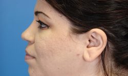 Liposuction 09 After