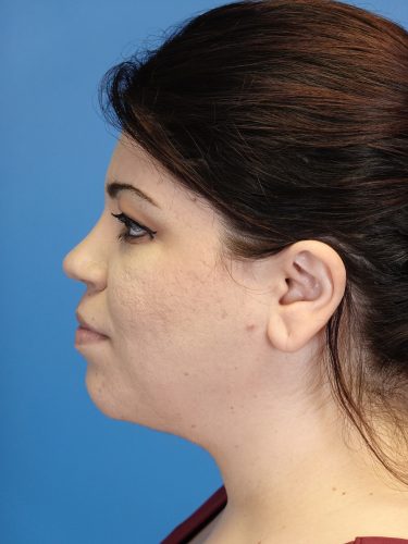 Liposuction 09 After 1