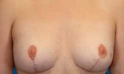 Breast Augmentation and Breast Lift 03 After